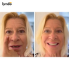 EYELIFT | OSYNLIG PERFEKTION FÖR ÖGONLYFT